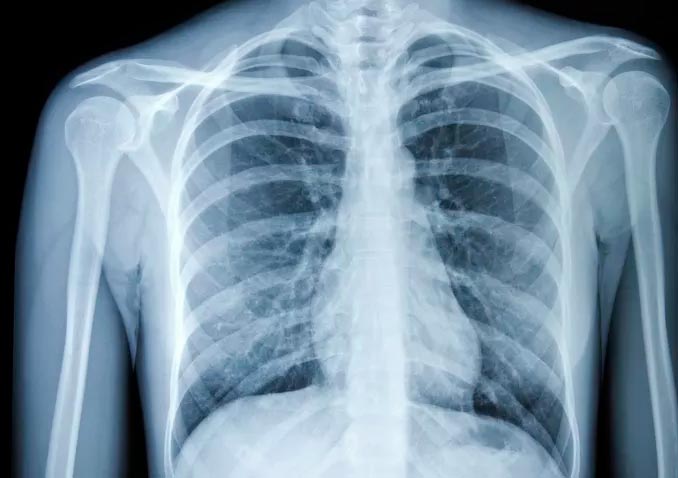 Critical Care Suite который анализирует рентген грудной клетки одобрен FDA Critical Care Suite который анализирует рентген грудной клетки одобрен FDA