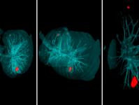 Исследователи разработали интеллектуальную систему диагностики рака легких